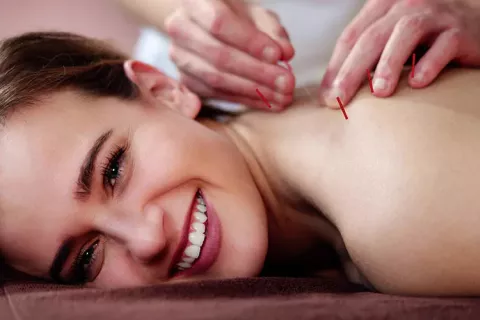 Mujer haciendo acupuntura